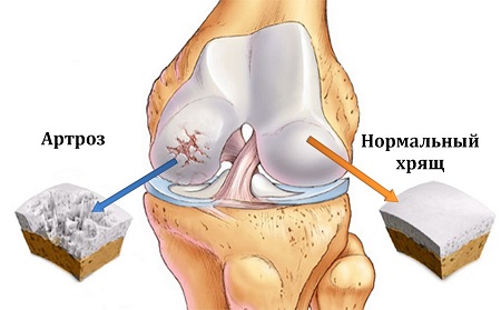 артроз сустава
